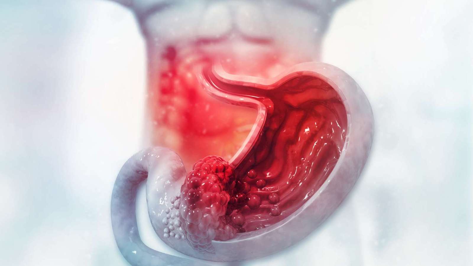 Gastrointestinal Bleeding in Adolescents: Causes & Treatment