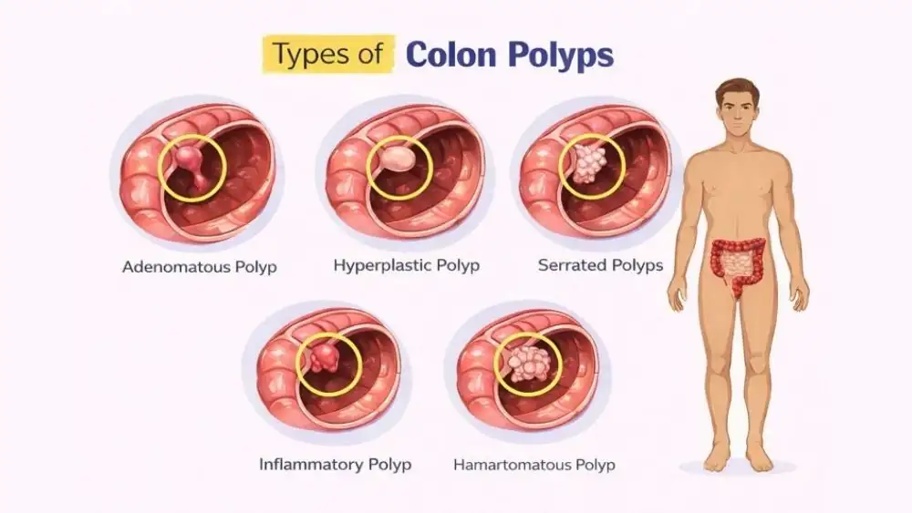 What Can a Colonoscopy Detect? Conditions, Findings & Limits 2 Types Of Colon Polyps