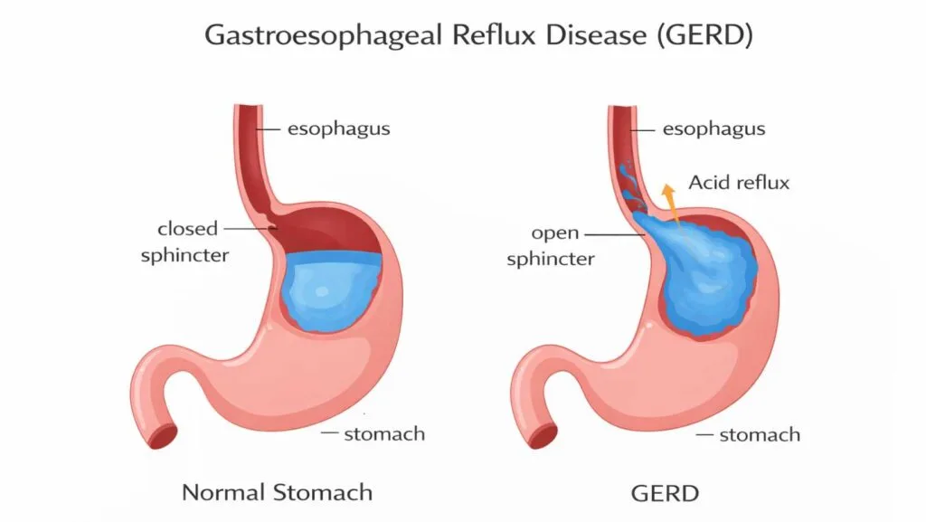 Gastroesophageal Reflux Disease (GERD)