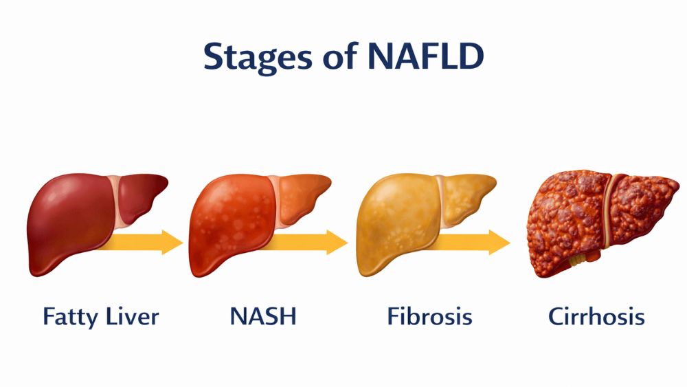 Stages of NAFLD