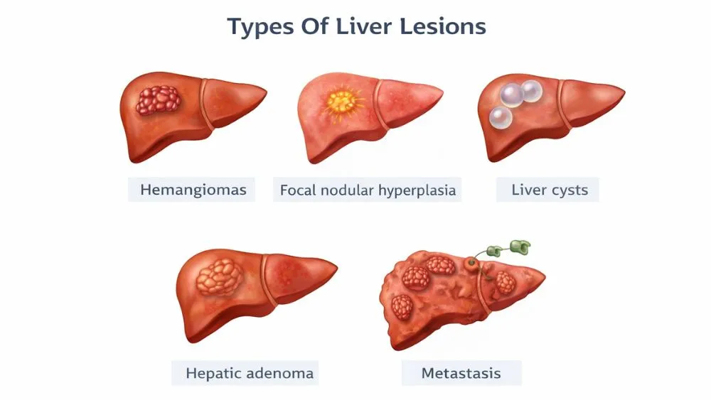 Types Of Liver Lesions