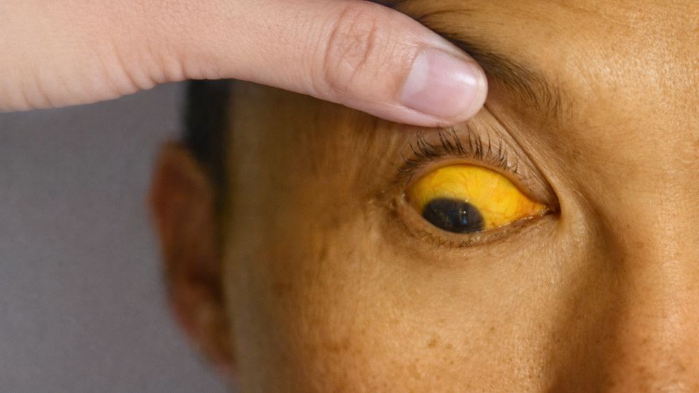 Jaundice in Liver Failure