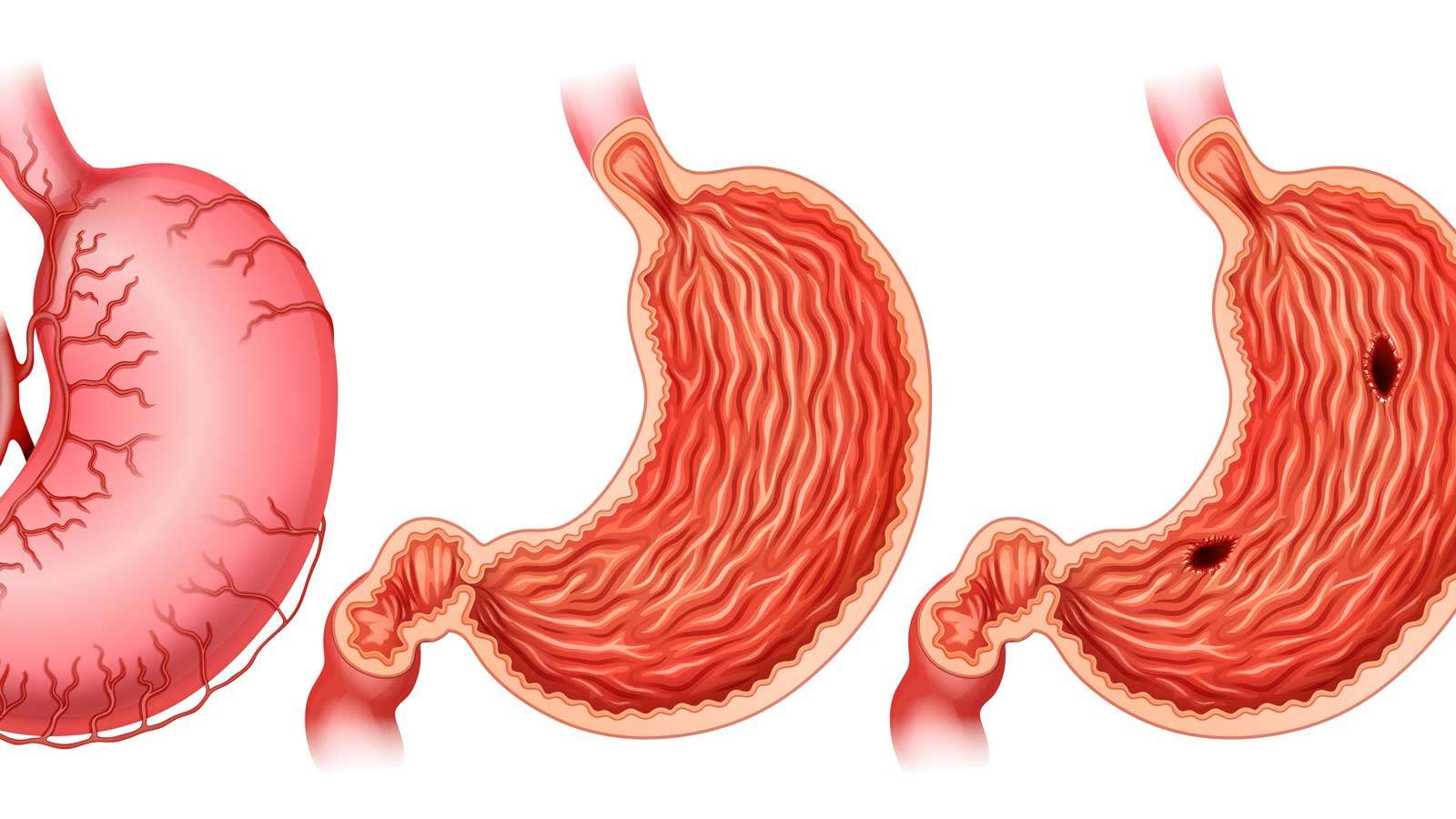 ulcer, गैस्ट्रोएंटरोलॉजिस्ट: आपके पाचन तंत्र के स्वास्थ्य के लिए महत्वपूर्ण, Case Study On Gastric Ulcer, Case Study - Severe Ulcerative Colitis | Dr. Nivedita Pandey