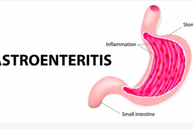 Gastroenteritis