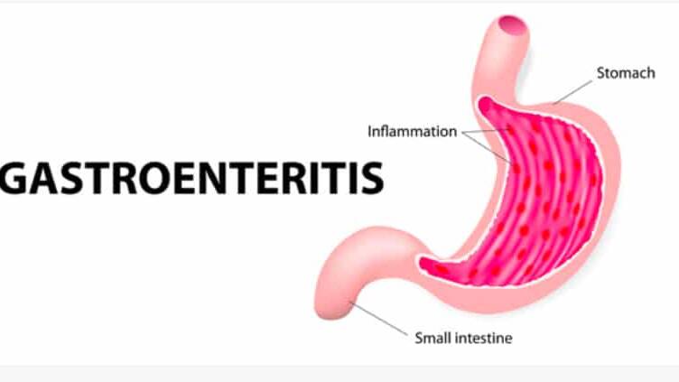 Gastroenteritis: Symptoms, Causes, Treatment, and Prevention 18 Gastroenteritis
