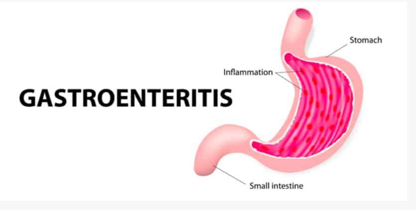 Gastroenteritis