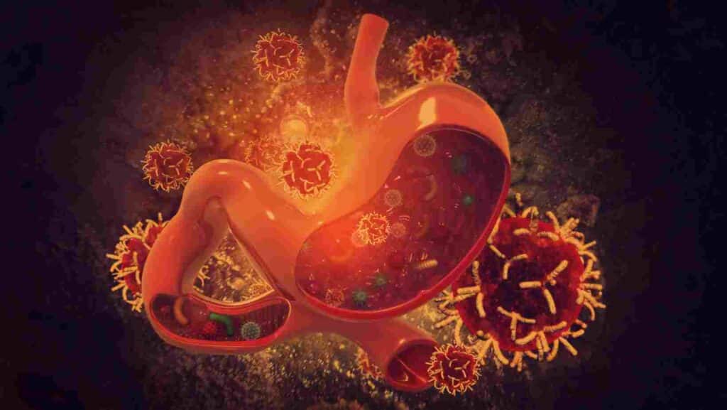 Stages of stomach cancer and treatment 4 Stages of stomach cancer