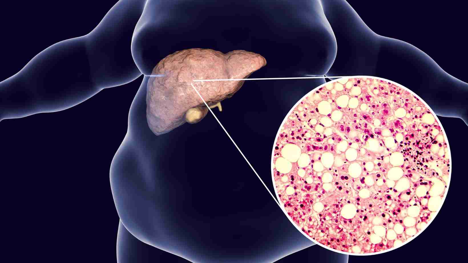 How long can you live without a liver transplant?