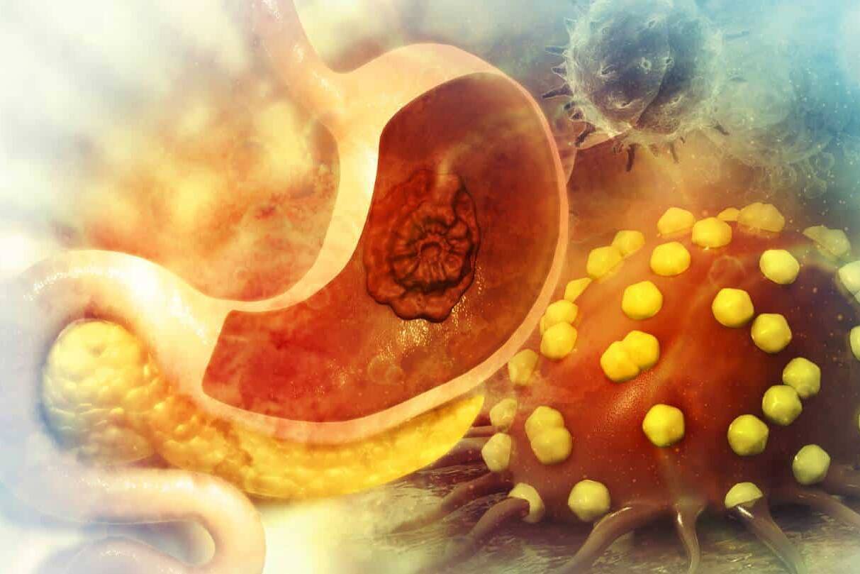 stomach cancer