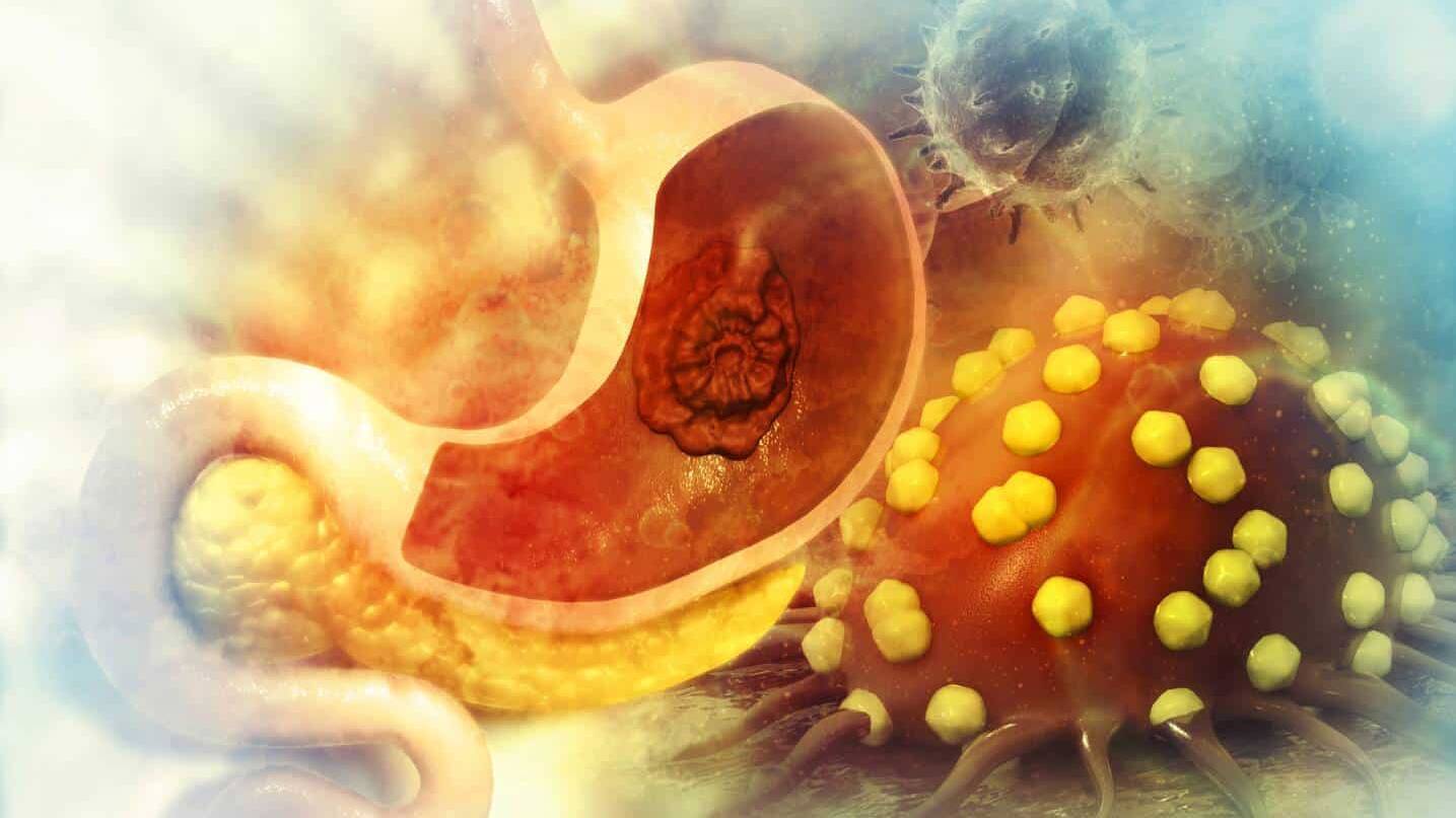 stomach cancer
