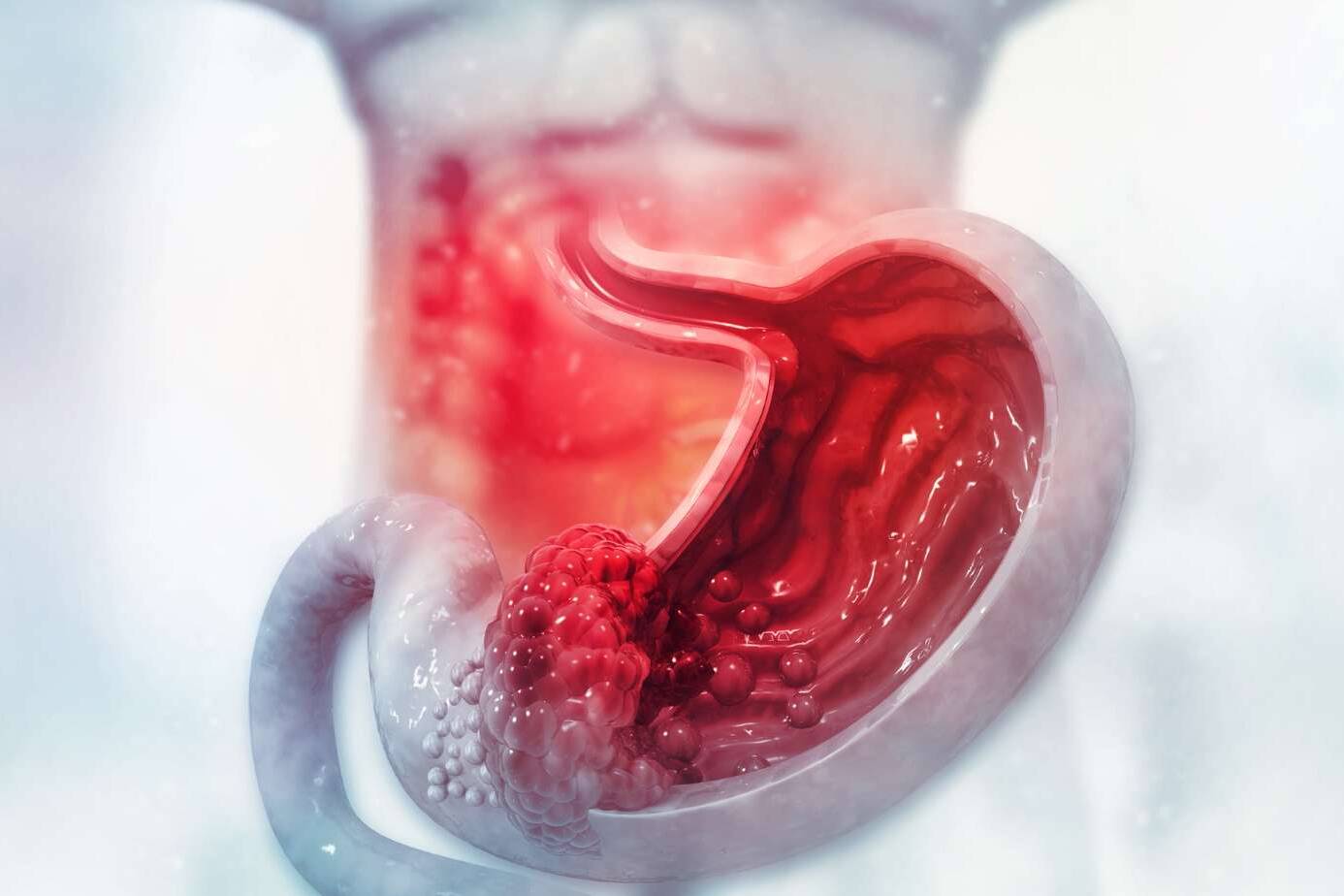 Gastrointestinal Bleeding in Adolescents: Causes & Treatment