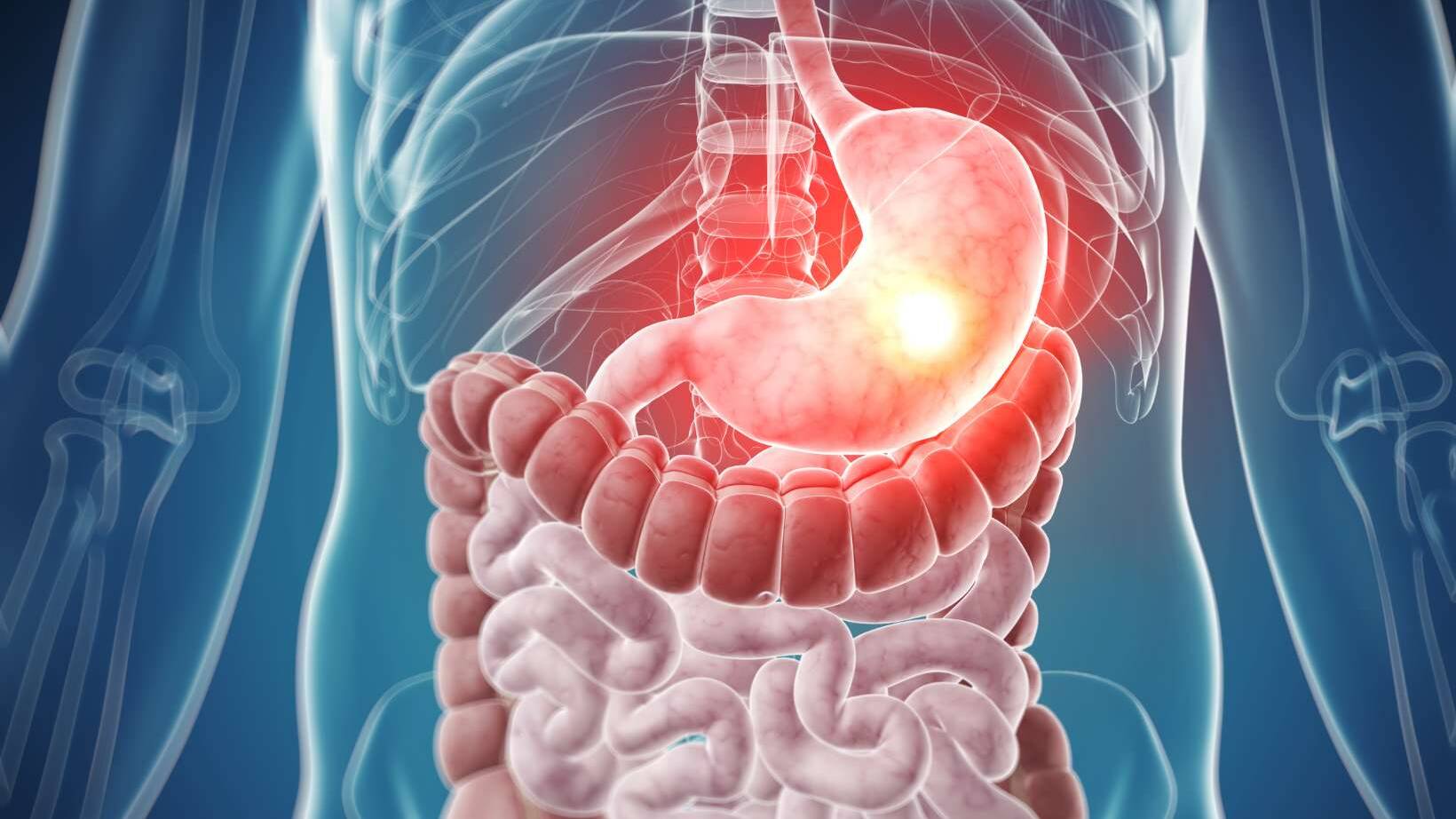 Nutrition for Stomach Cancer Patients: A Comprehensive Guide