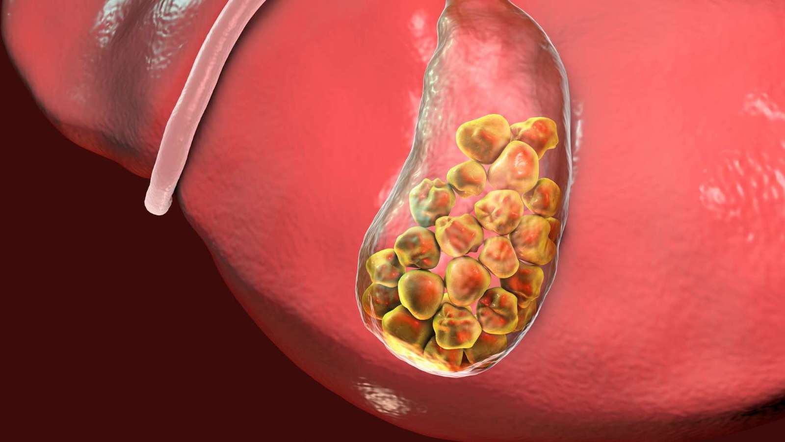 GallStones: What are they?