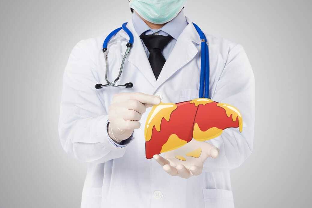 Non Alcoholic Fatty Liver disease (NAFLD): Causes, Symptoms and Treatment 7 Non Alcoholic Fatty Liver disease (NAFLD) Causes, Symptoms and Treatment