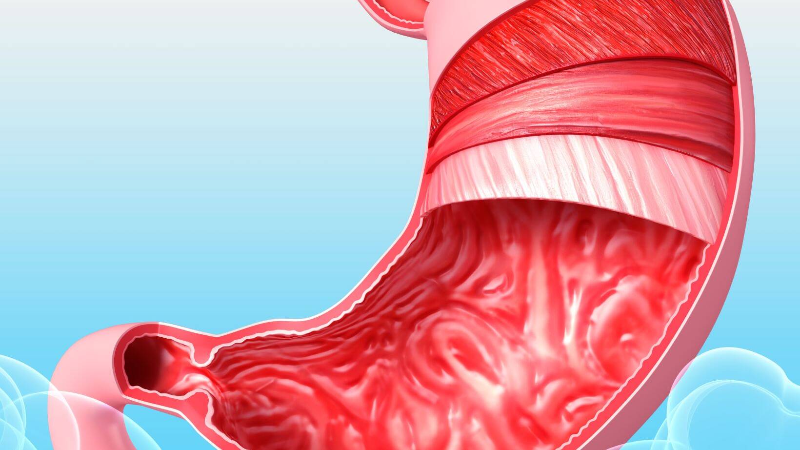 Barrett's Esophagus Symptoms