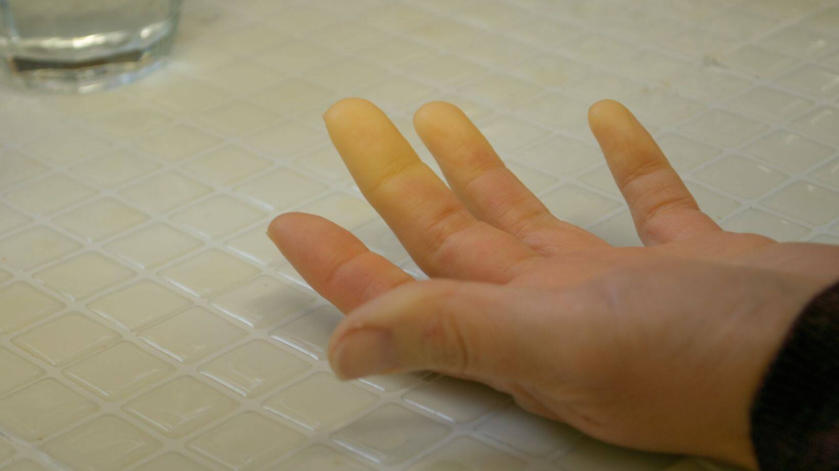 Biliary Atresia Symptoms