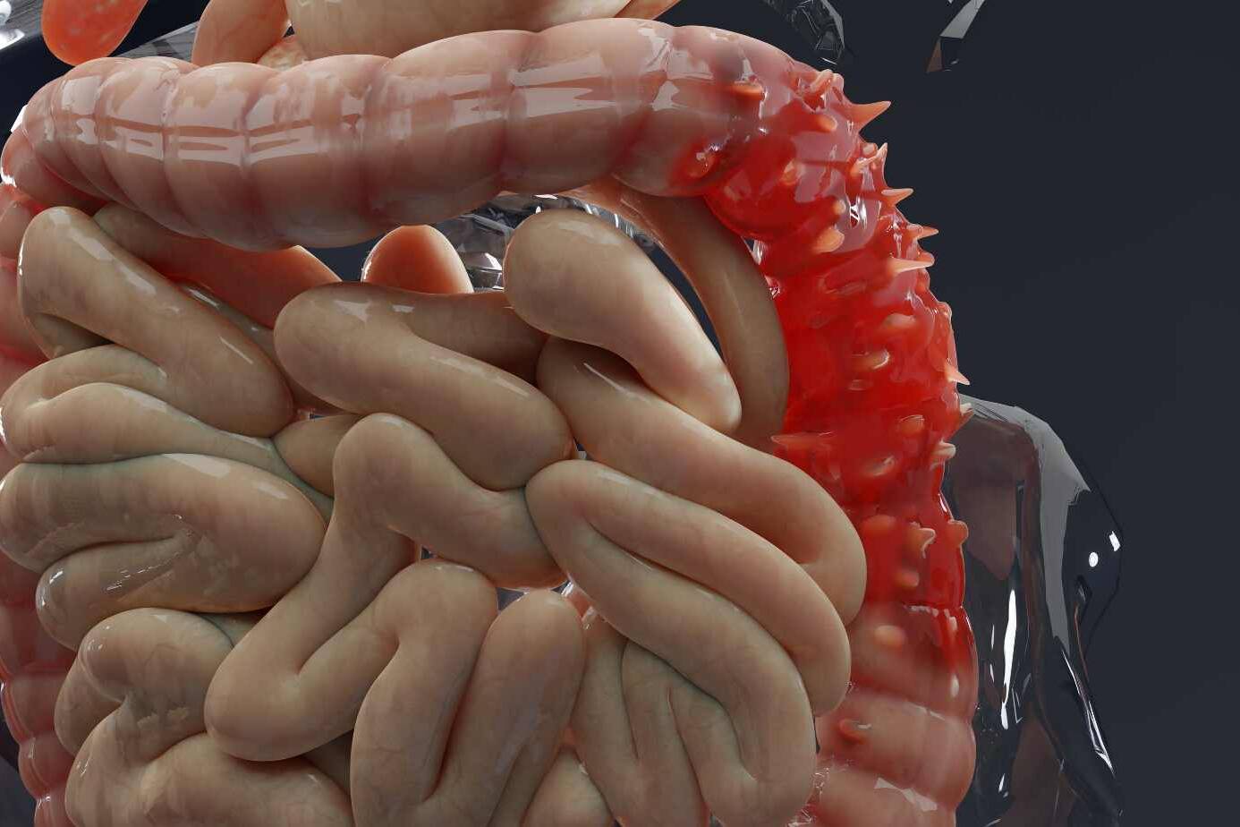 Diverticulitis Pain