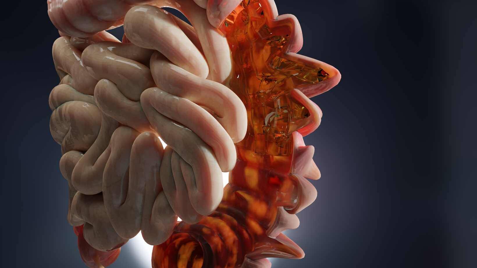 What Is Diverticulitis