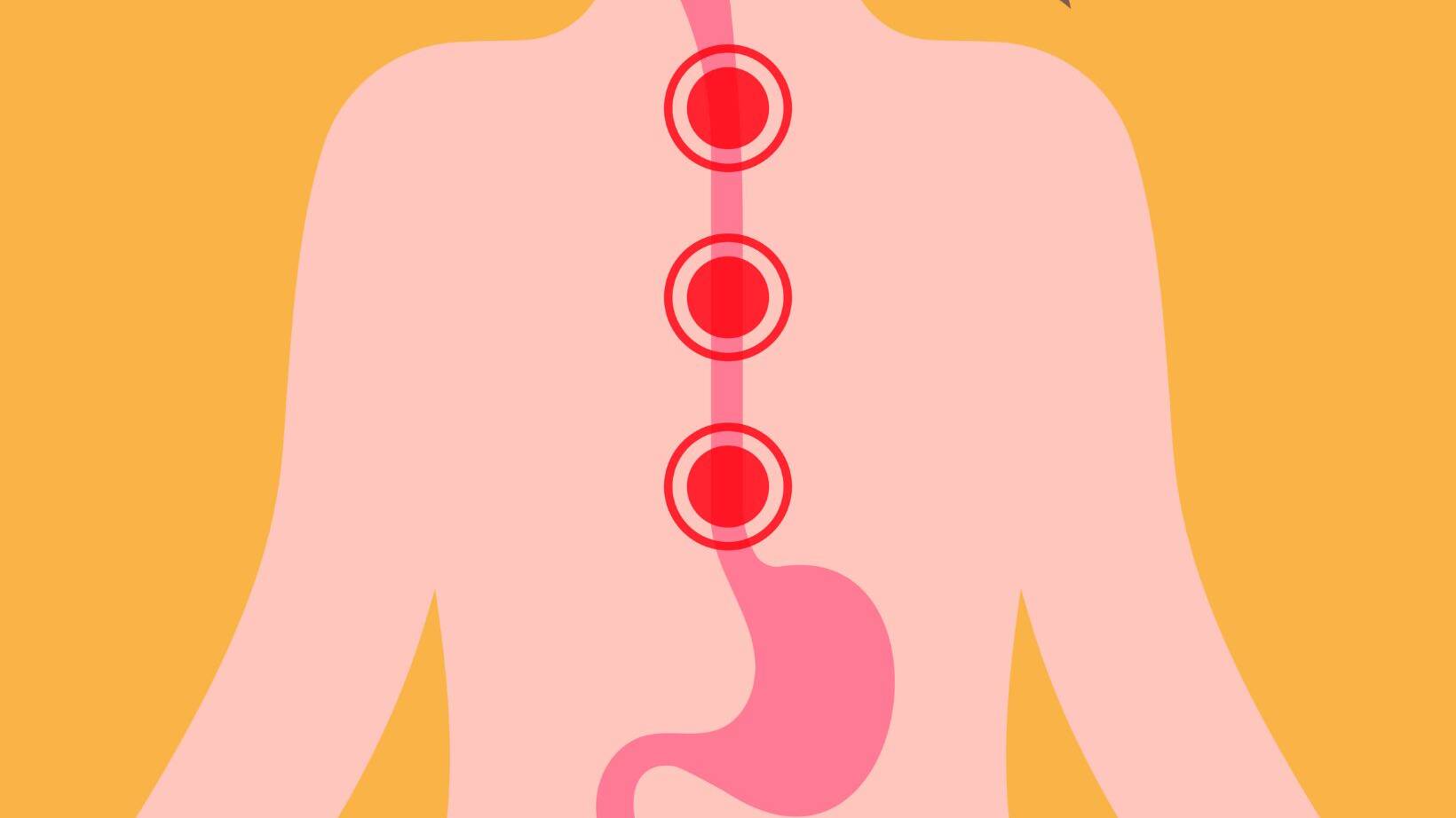 Signs of Barrett's Esophagus: Know the Symptoms 14 signs of barrett's esophagus