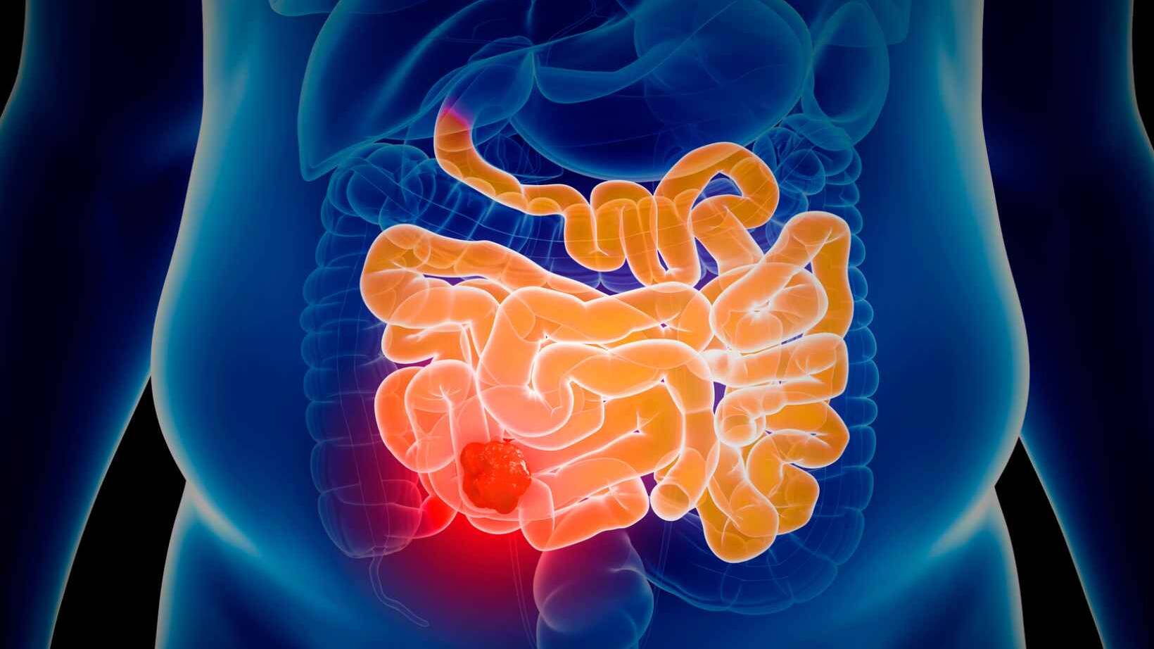 Understanding Bowel Cancer: Risks & Symptoms 14