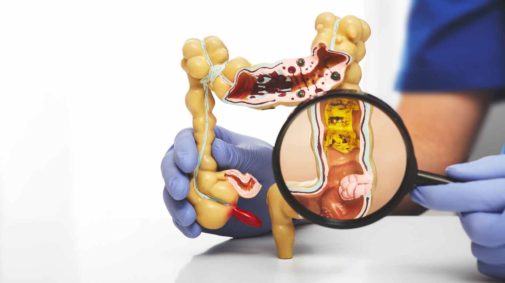Colonic Polyps Management: Expert Tips 11 Colonoscopy