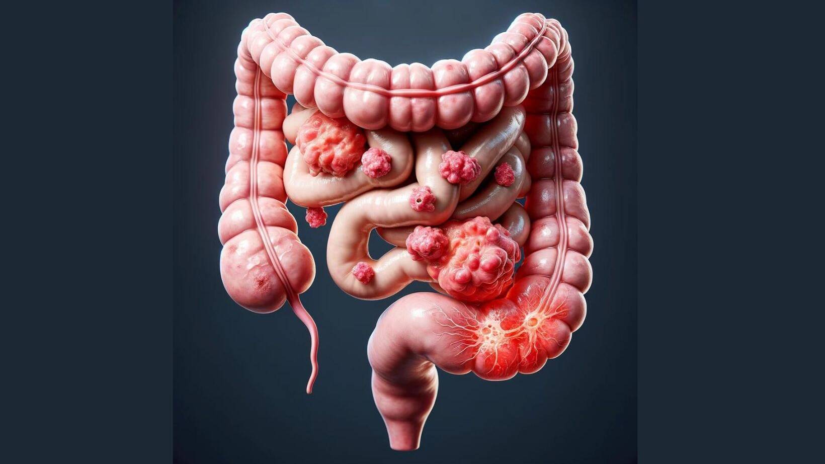 Early Signs of Bowel Cancer Symptoms Explained 13 Colon Cancer