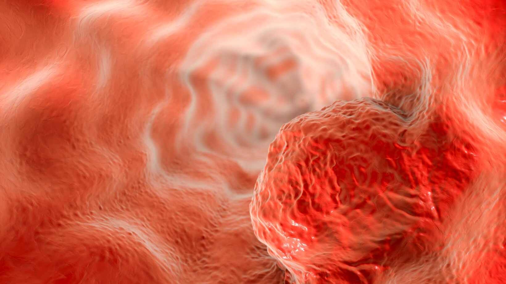 Causes Esophageal Cancer 15 Causes Esophageal Cancer