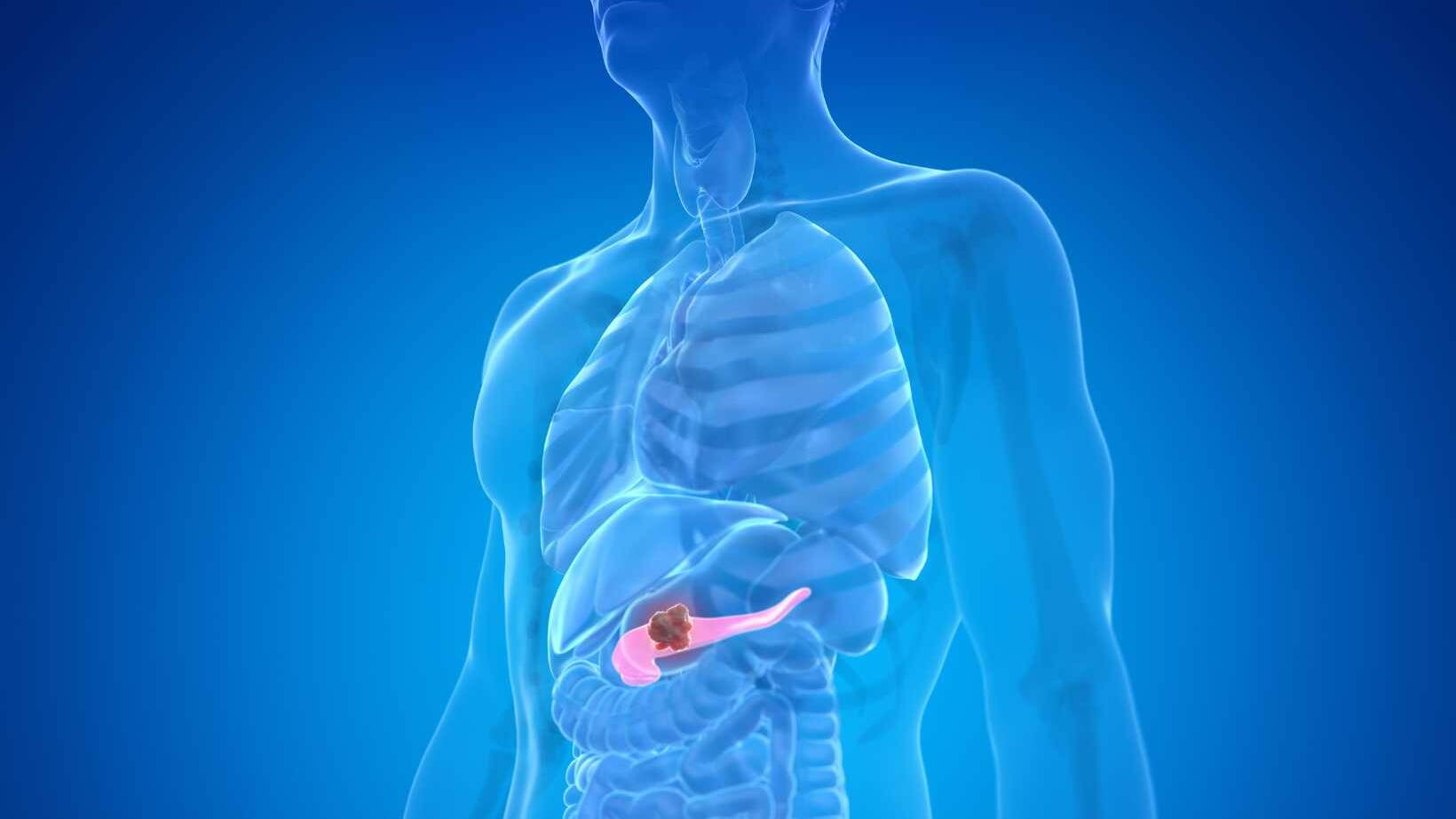 Understanding Chronic Pancreatitis: Symptoms, Causes, and Long-Term Management 15 Chronic Pancreatitis