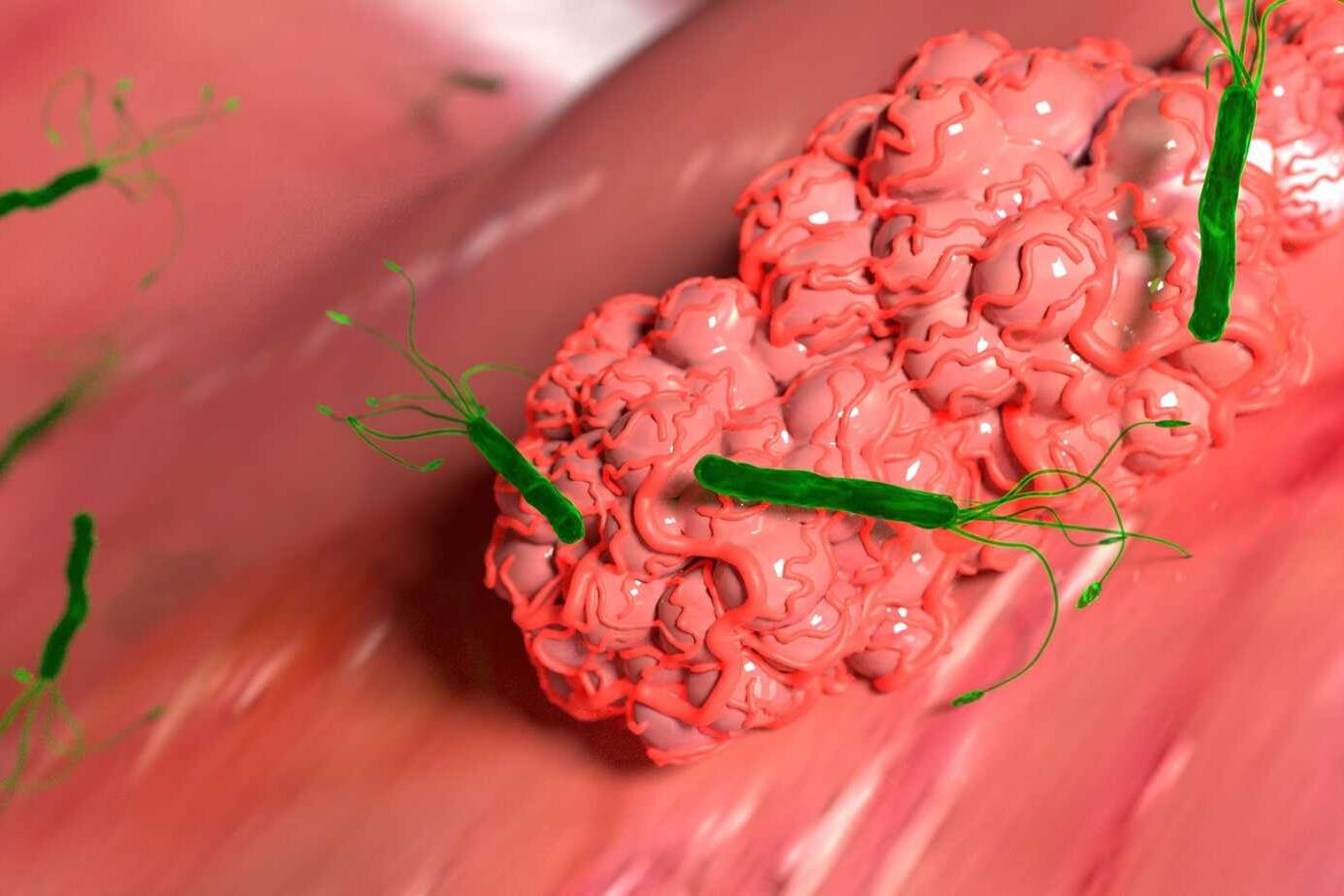 Effective Stomach Tumor Treatment: Medical, Surgical, and Advanced Options 2 Effective Stomach Tumor Treatment