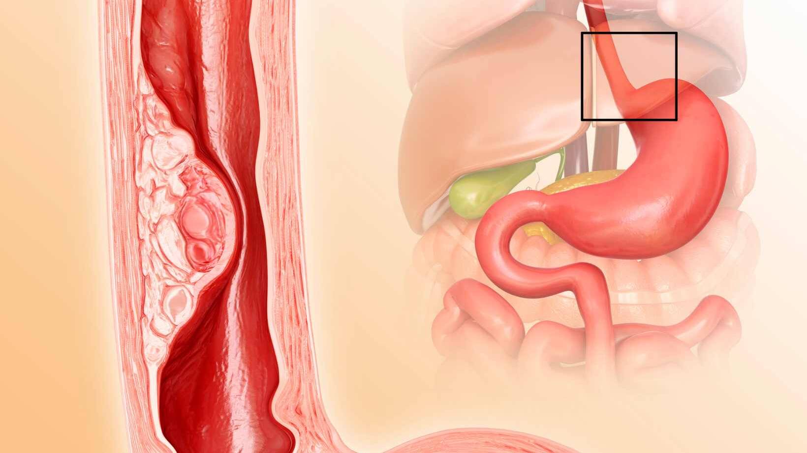 Esophageal Varices Treatment: Medical and Surgical Options 12 Blood Transfusions