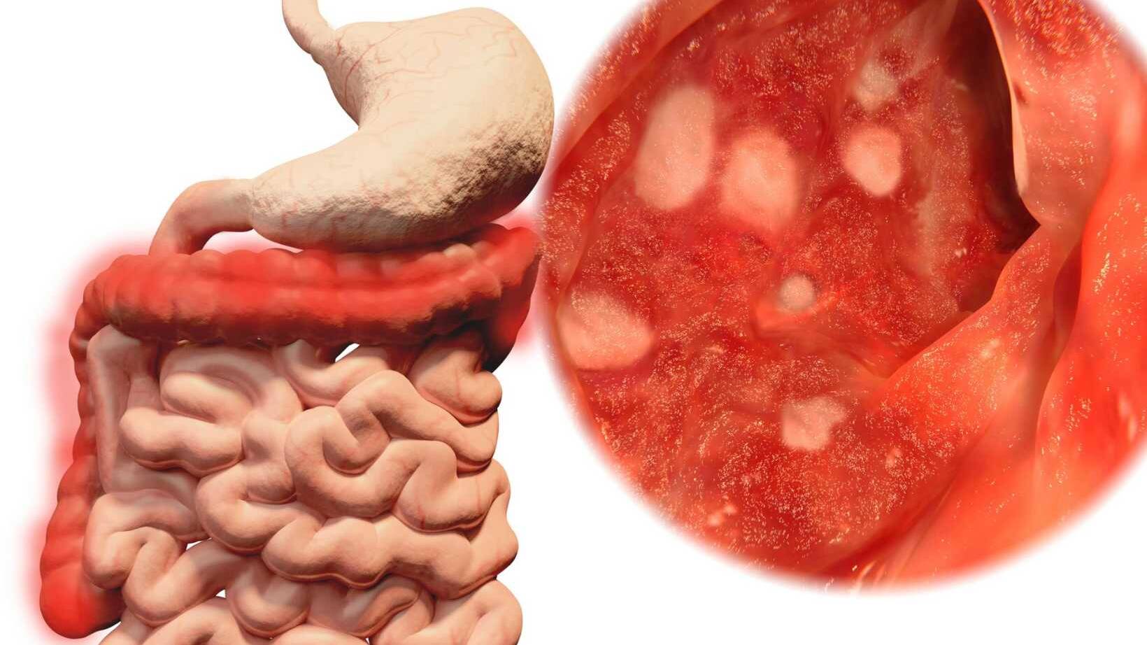 How to Heal Stomach Ulcers: Effective Strategies for Recovery 14 What is Stomach Ulcers,How to Heal Stomach Ulcers: Effective Strategies for Recovery