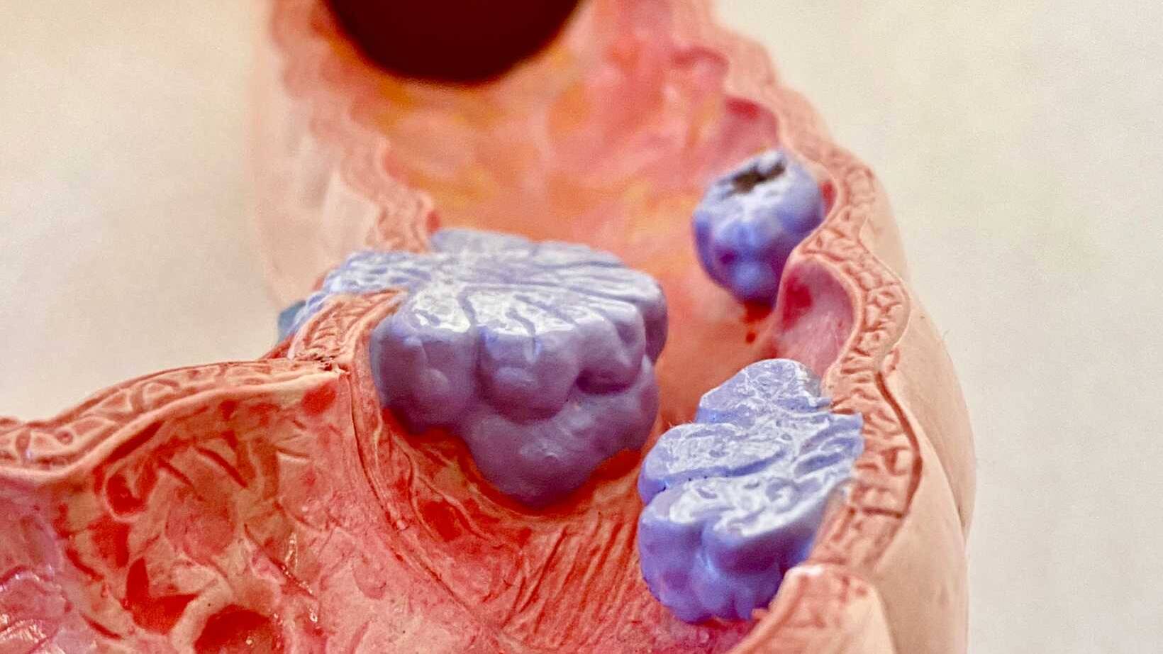 Symptoms of Rectal Polyps: Identifying Early Warning Signs 1 Symptoms of Rectal Polyps Identifying Early Warning Signs