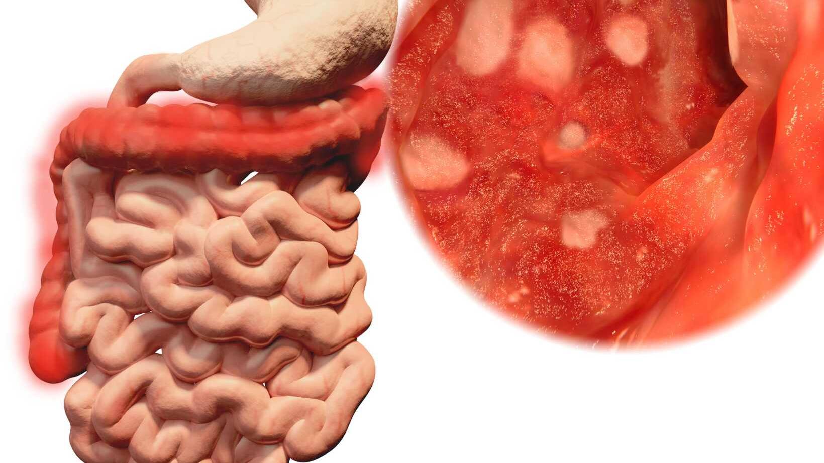 What is Stomach Ulcers? Understanding This Common Digestive Condition 9 What Are Stomach Ulcerss, Ulcerative Colitis Treatment, What is Ulcerative Colitis