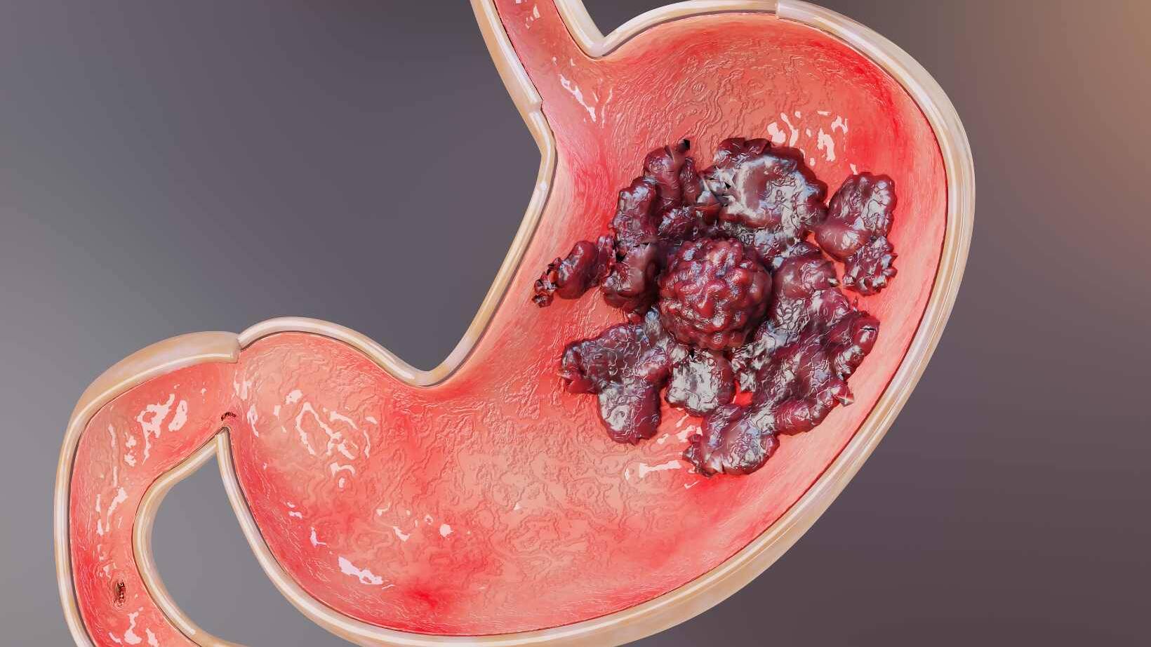 What Causes Gastric Cancer? Exploring the Risk Factors 19