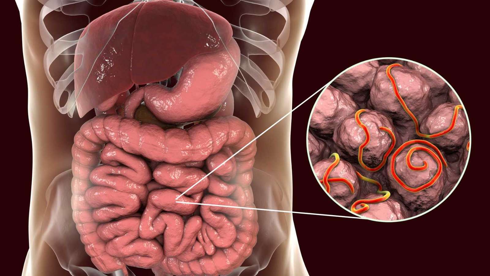 What is Intussusception