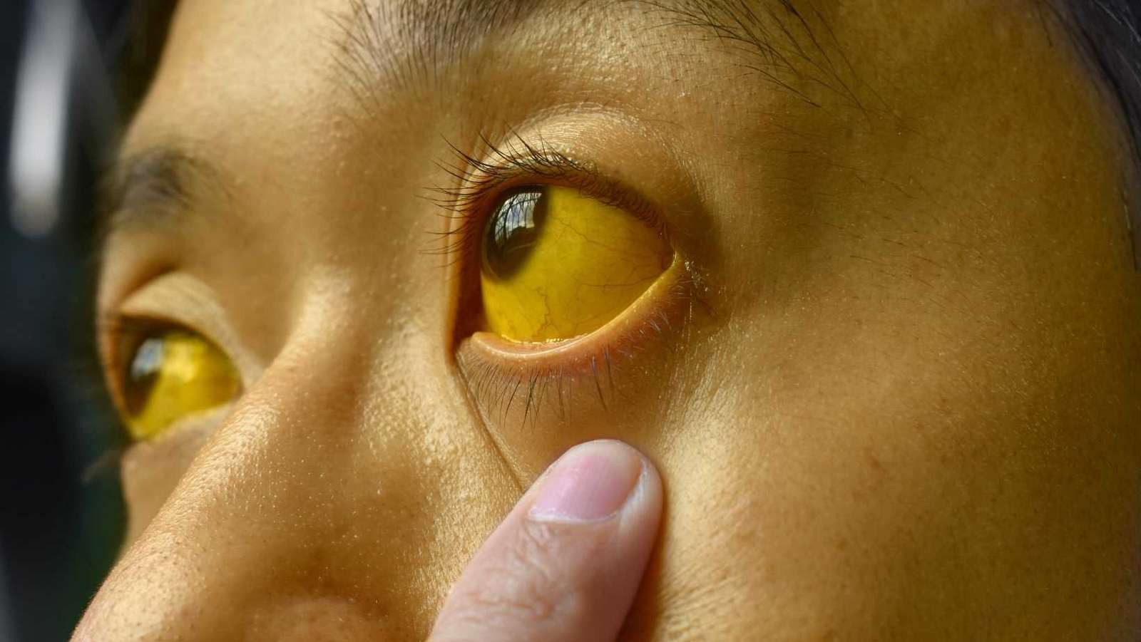 What is Jaundice?