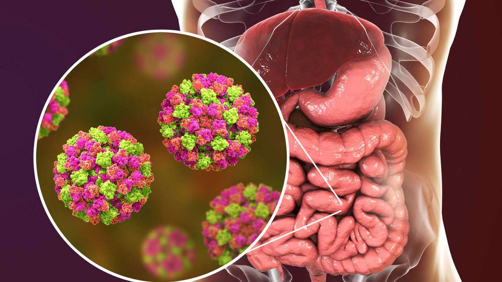 What is Norovirus Infection? Understanding the Stomach Bug and How it Spreads