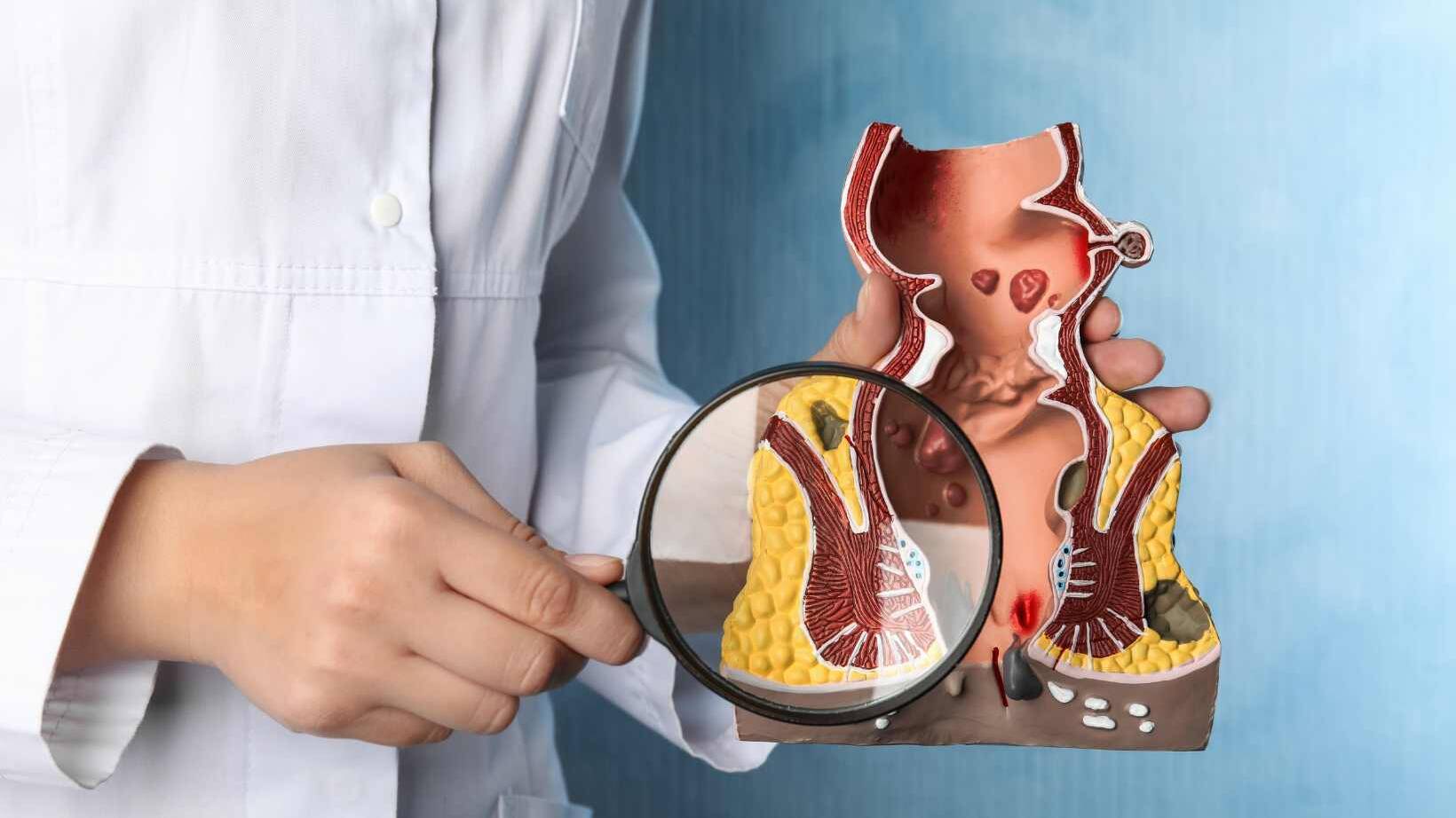 What is a Fistula? Understanding the Basics 11 What is a Fistula? Understanding the Basics