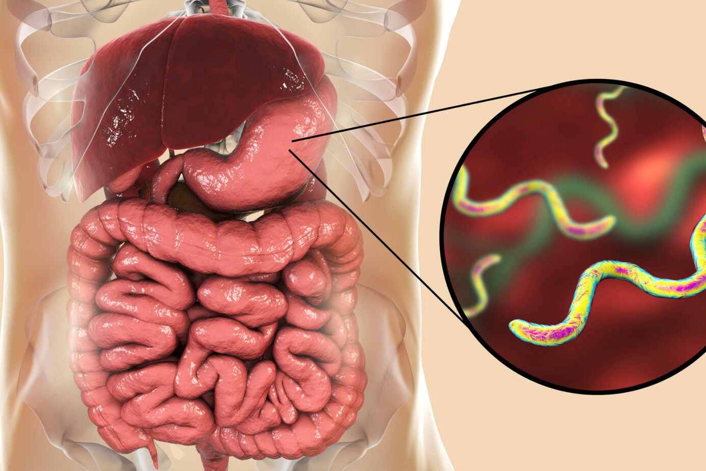 what is helicobacter pylori infection