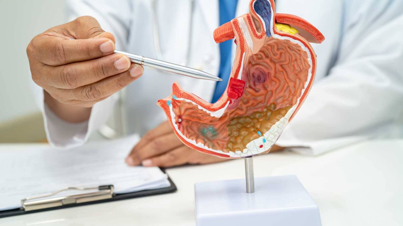 Effective Peptic Ulcer Disease Treatments: Medical and Lifestyle Approaches 7 Peptic Ulcer Treatment,Effective Peptic Ulcer Disease Treatments