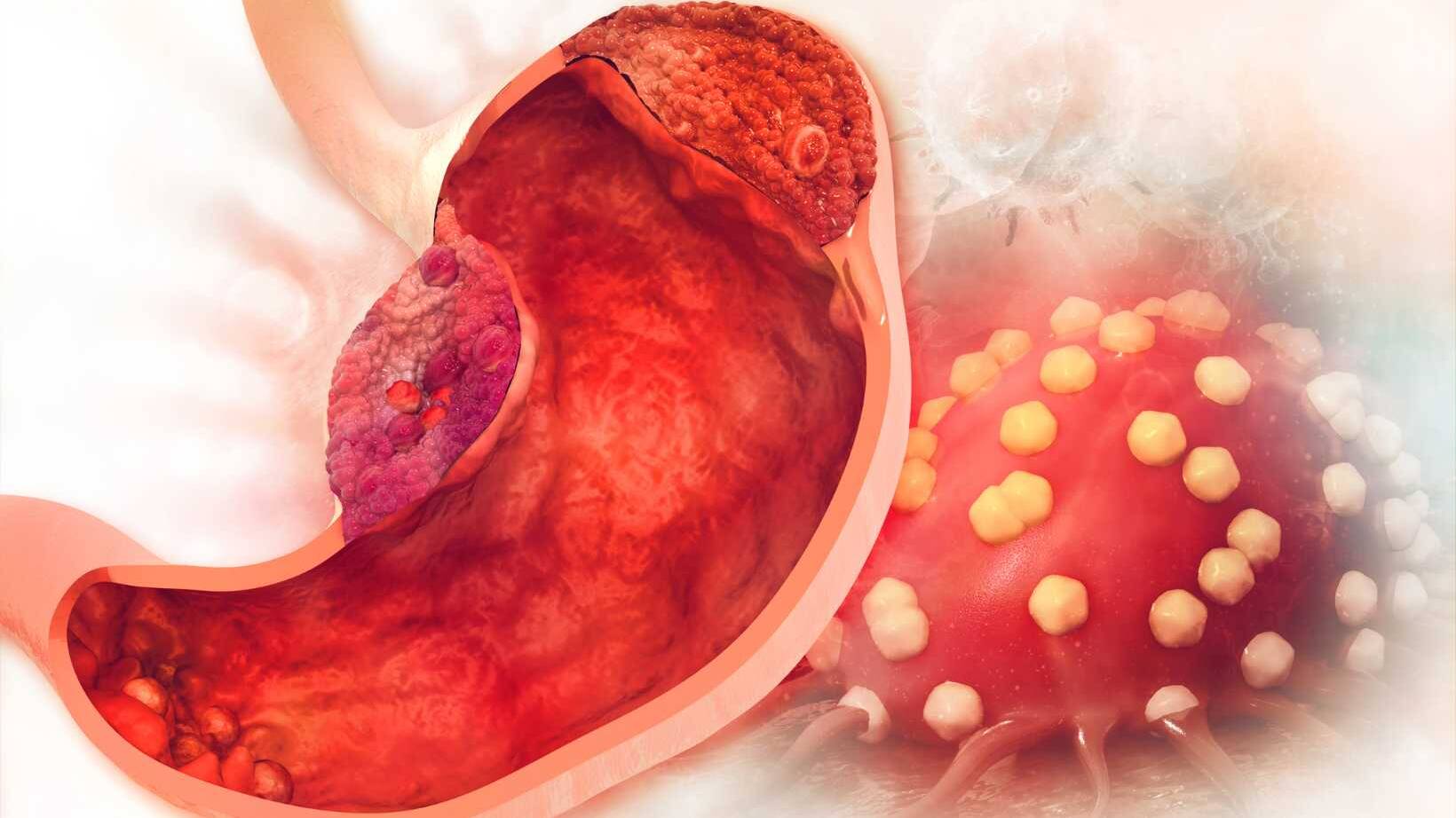 What is Peptic Ulcer Disease? Understanding Causes, Symptoms, and Treatments 1 peptic ulcer specialist