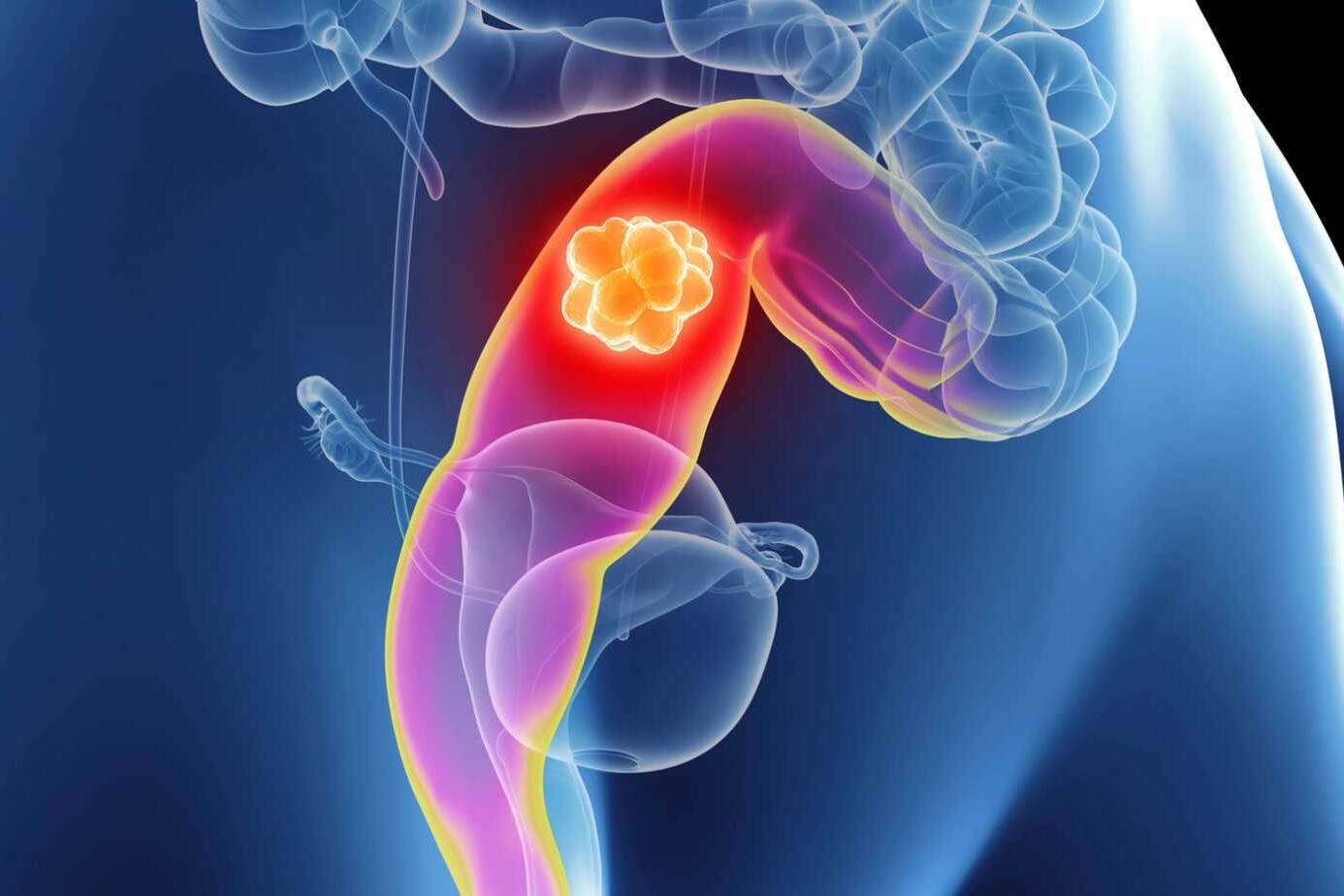 Sigmoid Colon Cancer Symptoms: Early Detection and Diagnosis 6 sigmoid colon cancer signs and symptoms