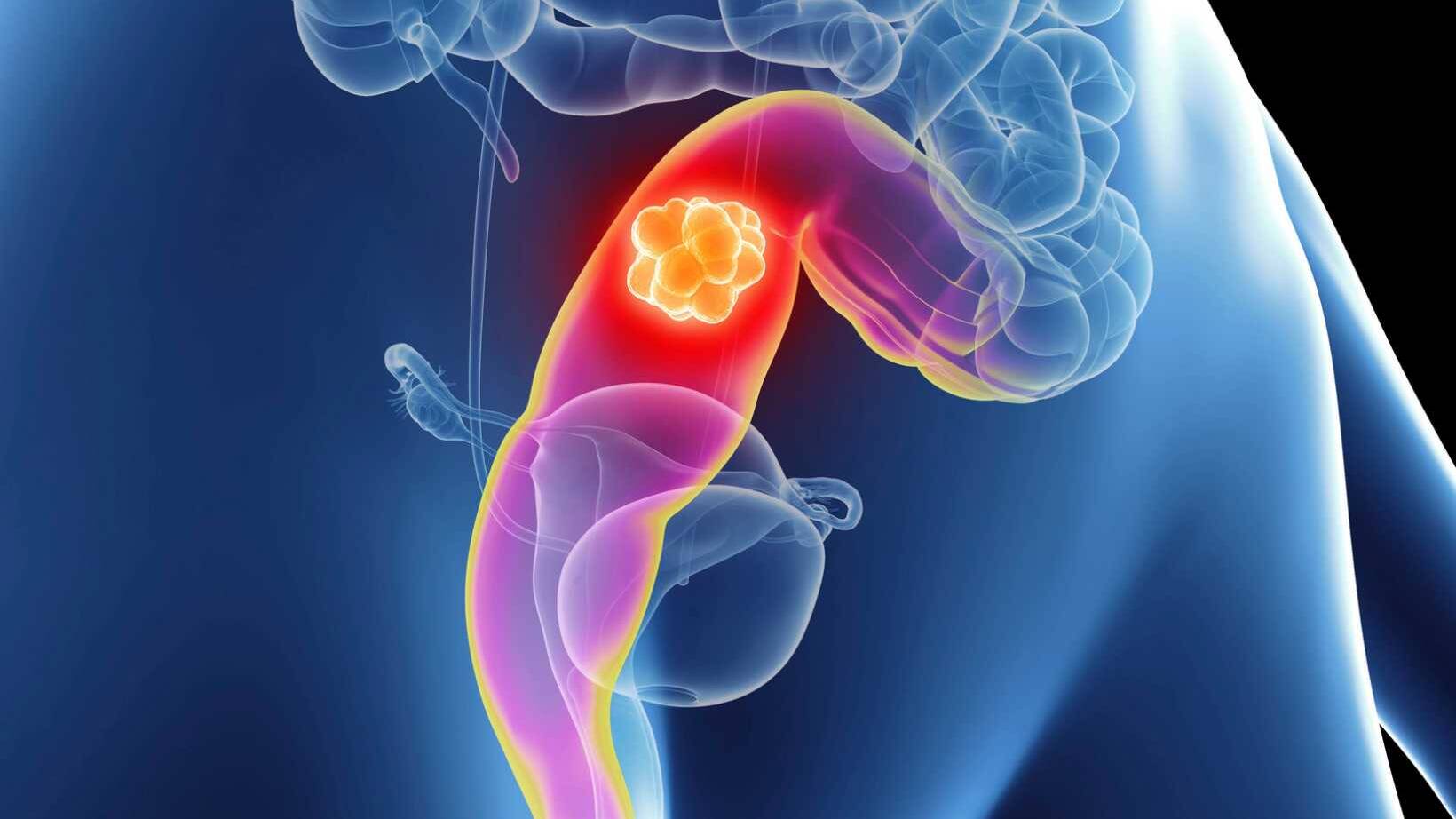 Sigmoid Colon Cancer Signs And Symptoms: Early Detection and Diagnosis 18 sigmoid colon cancer signs and symptoms