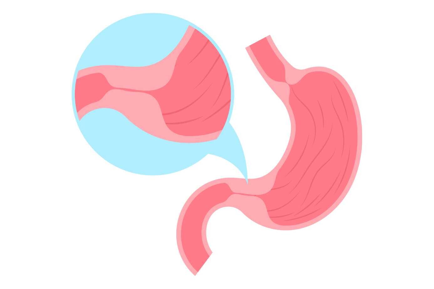 What is Pyloric Stenosis? Understanding This Infant Digestive Condition 2 what is pyloric stenosis