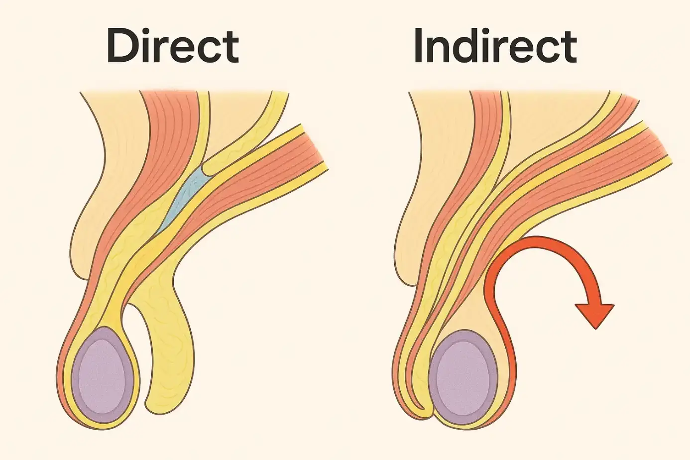 Direct vs Indirect Hernia: Key Differences, Symptoms, and Treatment Options 10 direct vs indirect hernia