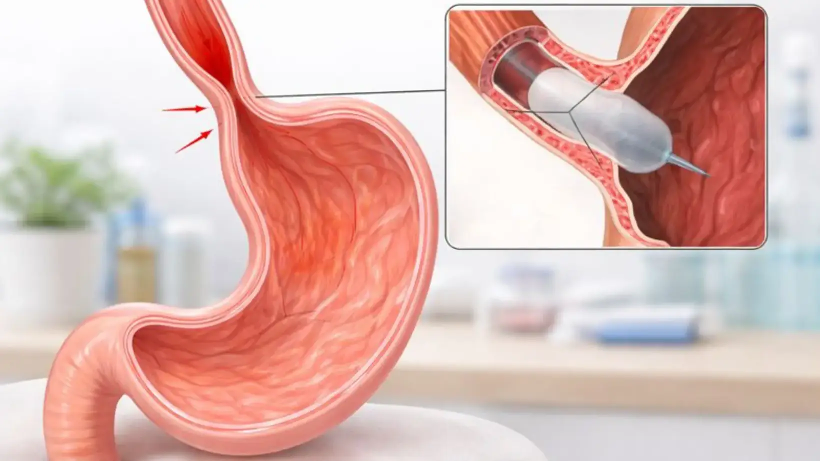 Achalasia Treatment: Complete Guide to Options & Recovery 2 achalasia treatment