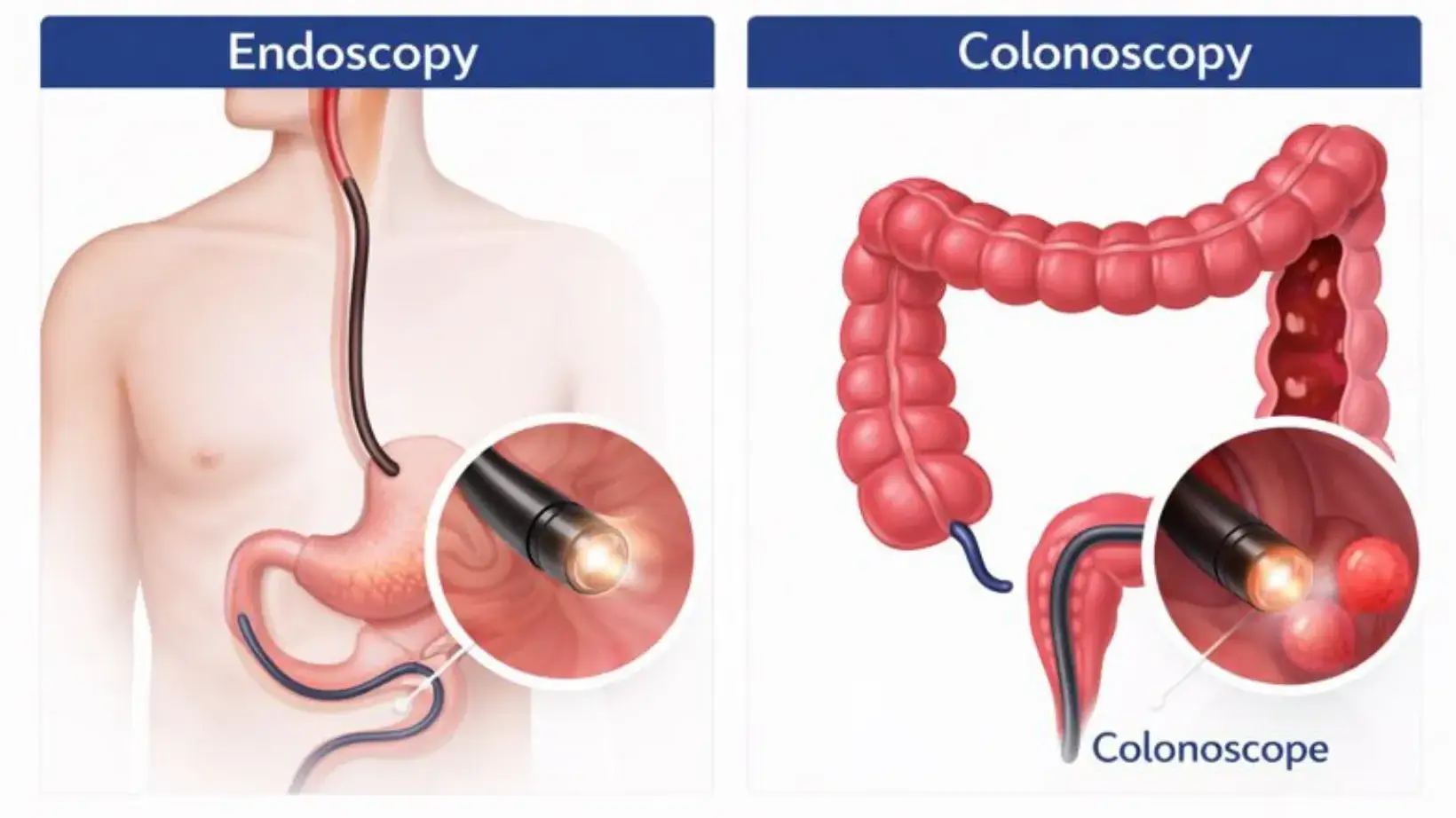 endoscopy vs colonoscopy
