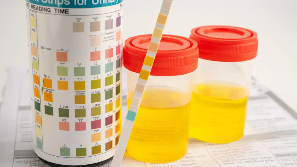 Bilirubin In Urine: Causes, Symptoms, And What It Means