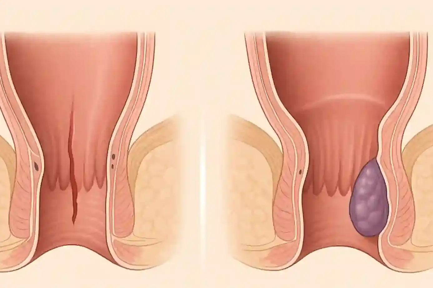 anal fissure vs hemorrhoid