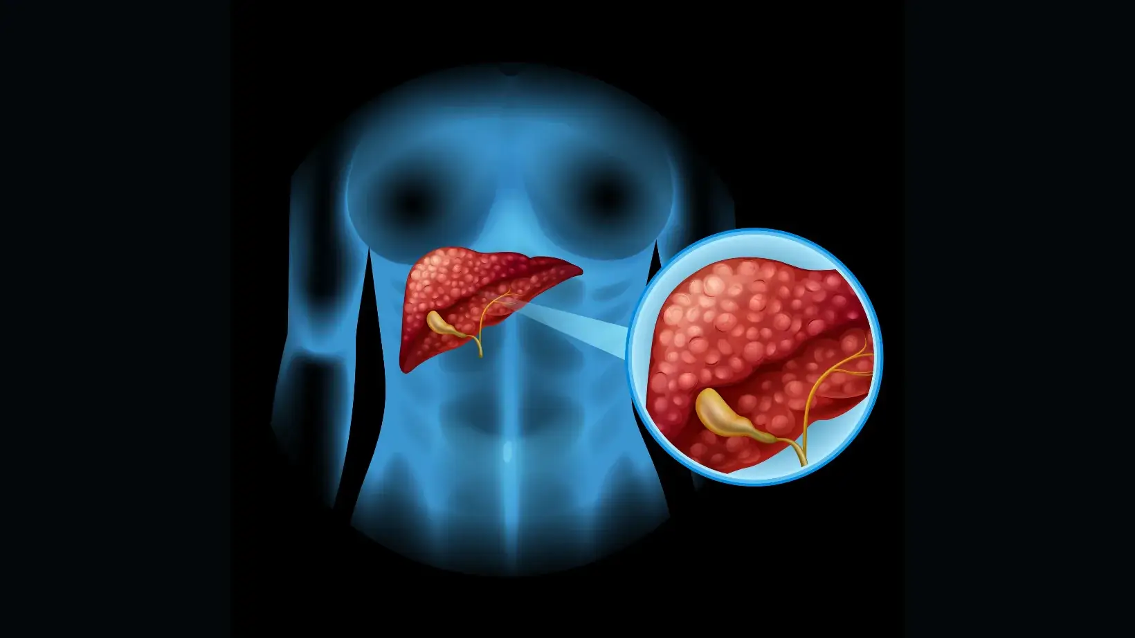 liver parenchymal disease